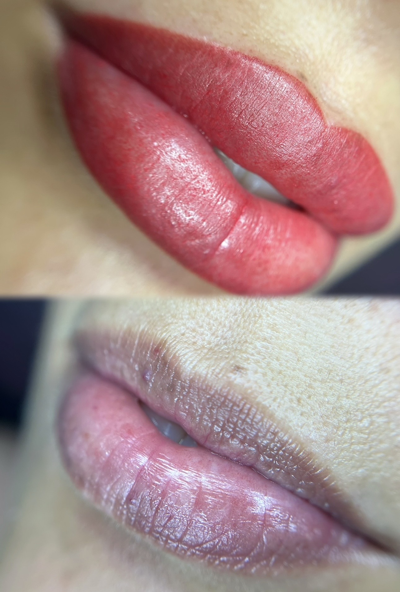 Antes y después de una neutralización de labios oscuros